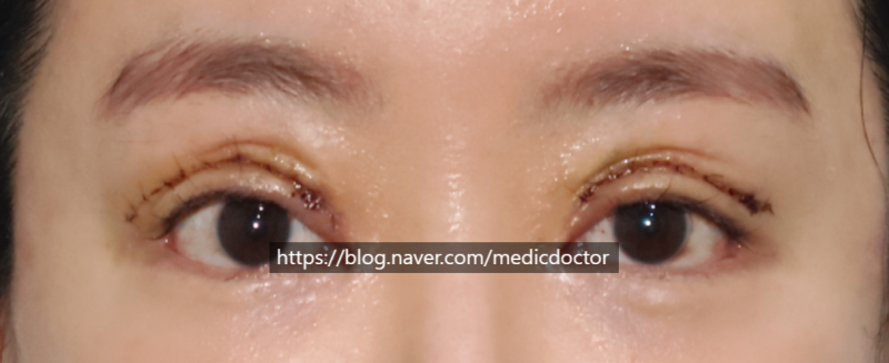Double Eyelid Revision Surgery: Correction Timing and Methods for Double Folds
