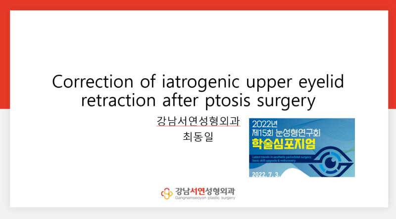 안검퇴축술이란? 과교정된 눈매교정 재수술 A to Z | 강남서연성형외과 안검퇴축 재수술