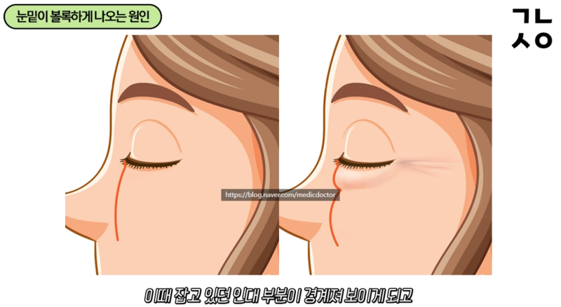 눈밑지방재배치술 완벽 가이드 | 다크서클, 눈물고랑, 눈밑애교살 고민 해결