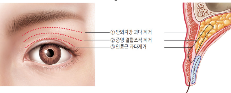 눈위 꺼짐 치료 눈두덩이 지방이식,눈위 지방꺼짐 두줄따기