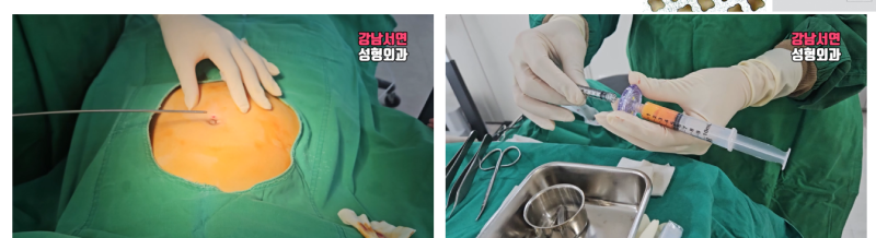 눈위 꺼짐 치료 눈두덩이 지방이식,눈위 지방꺼짐 두줄따기 사진 4