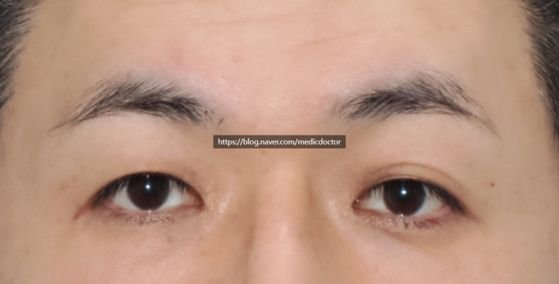 男士双眼皮去除，我在诊室里常听到的话题