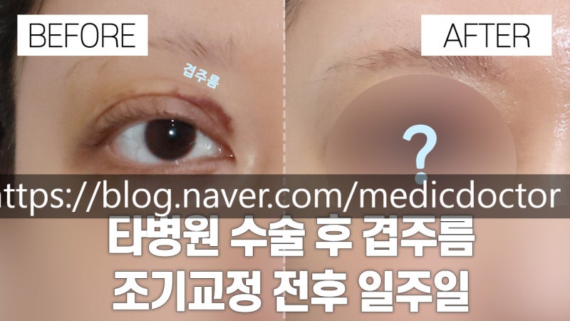 切开法双眼皮早期修复：适用情况与处理方案