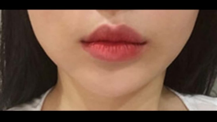 메가V라인 너두 V라인만들어야지