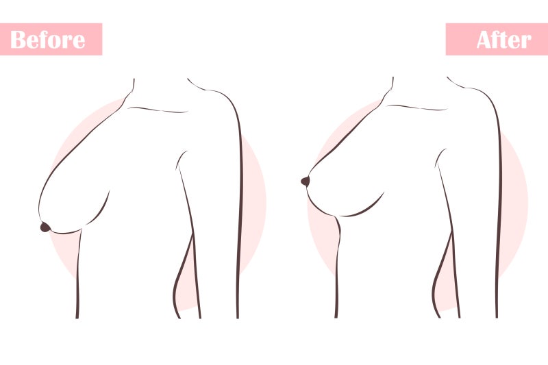 다이어트 가슴처짐 신경서야 할 팁