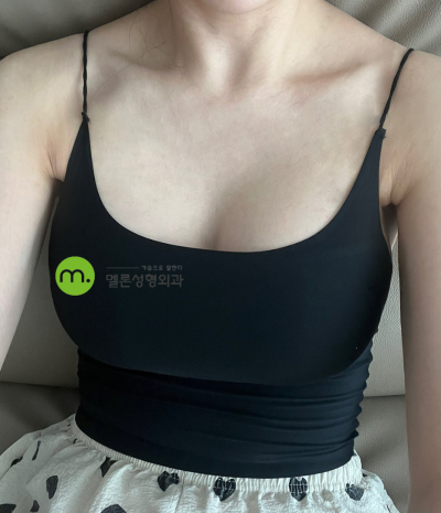 A컵에서 C컵으로? 세빈 서브리미티 가슴성형후기🍈