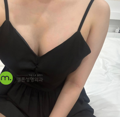 멜론성형외과의 멘토 엑스트라 가슴성형후기🍈