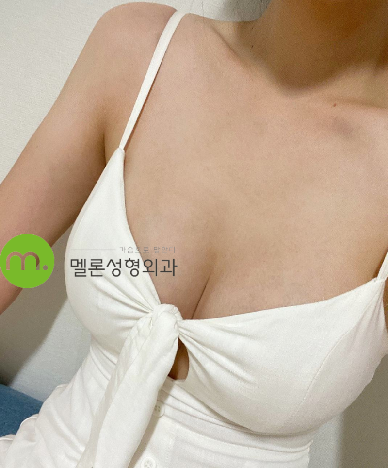 가슴성형 6개월 차, 모티바 풀 375cc의 모양은?