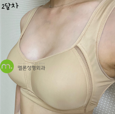 隆乳手術六個月後，Motiva Full 375cc 的形狀如何？