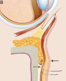 👀 Lower Blepharoplasty and Under-Eye Fat Repositioning: How to Fix Sagging Under-Eyes?