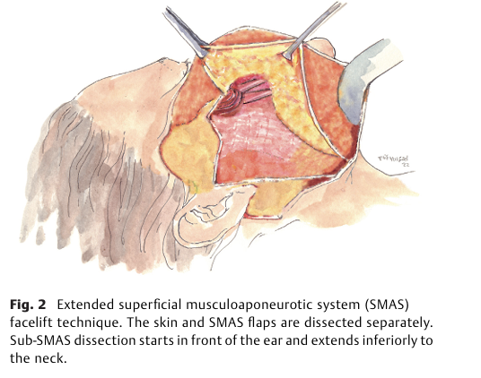 Comparing Facelift Satisfaction: Why Retaining Ligament Dissection is More Effective 사진 2