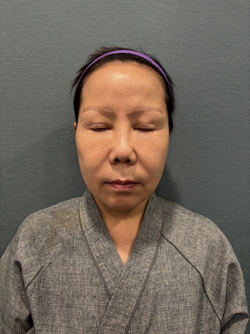 Double Eyelid Revision Surgery: Lowering ‘Sausage Eyes’ and Post-Surgery Review 사진 2