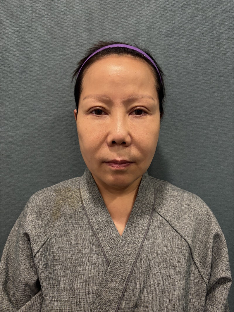 Double Eyelid Revision Surgery: Lowering ‘Sausage Eyes’ and Post-Surgery Review