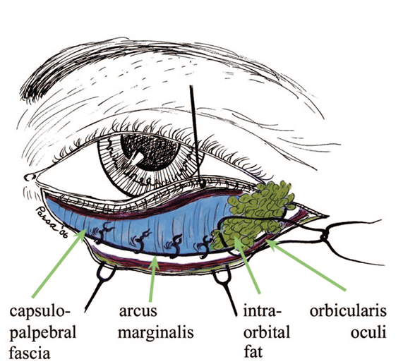 Lower Blepharoplasty Core: Natural, Rejuvenating Methods with Fat Repositioning, Fat Removal, and Septal Tightening 사진 2