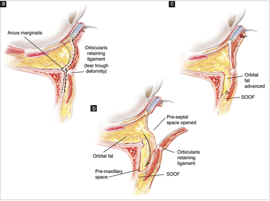 Lower Blepharoplasty Core: Natural, Rejuvenating Methods with Fat Repositioning, Fat Removal, and Septal Tightening