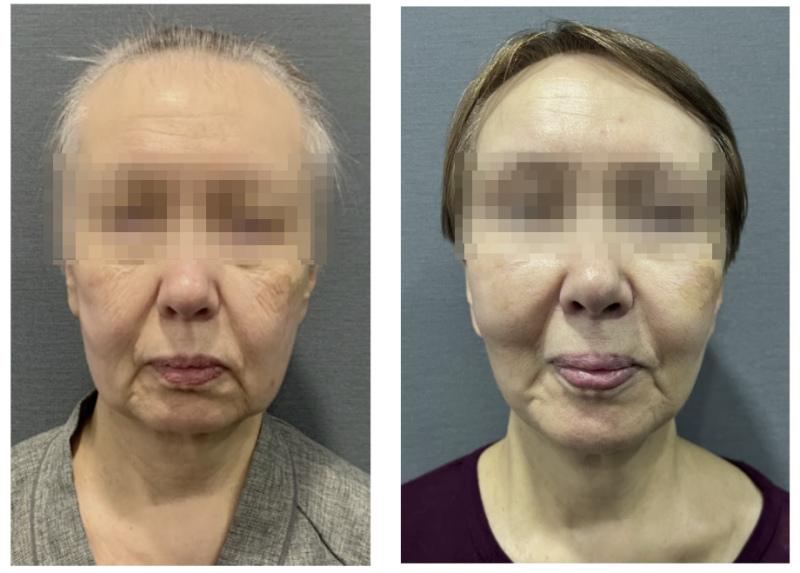 Gangnam Facelift: Is a Mini-Lift Enough? Naturalness, Cost, and Selection Criteria Explained 사진 4