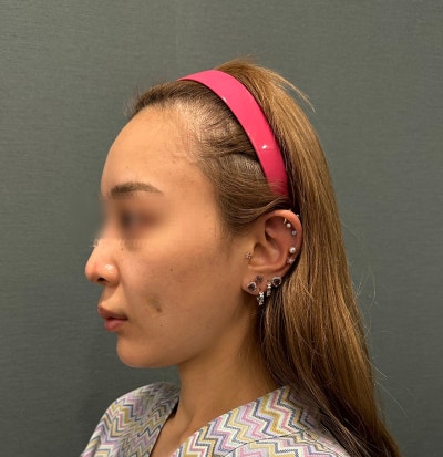 Gangnam Facelift: Is a Mini-Lift Enough? Naturalness, Cost, and Selection Criteria Explained 사진 5