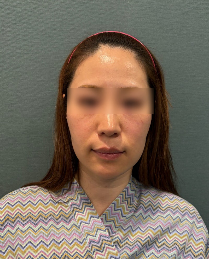 Sinnonhyeon Station Plastic Surgery Clinic: Thread Lift – How Long Do Effects Last and How Does Naturalness Differ? 사진 6