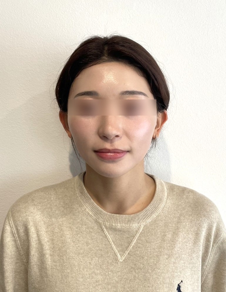 Sinnonhyeon Station Plastic Surgery Clinic: Thread Lift – How Long Do Effects Last and How Does Naturalness Differ? 사진 9