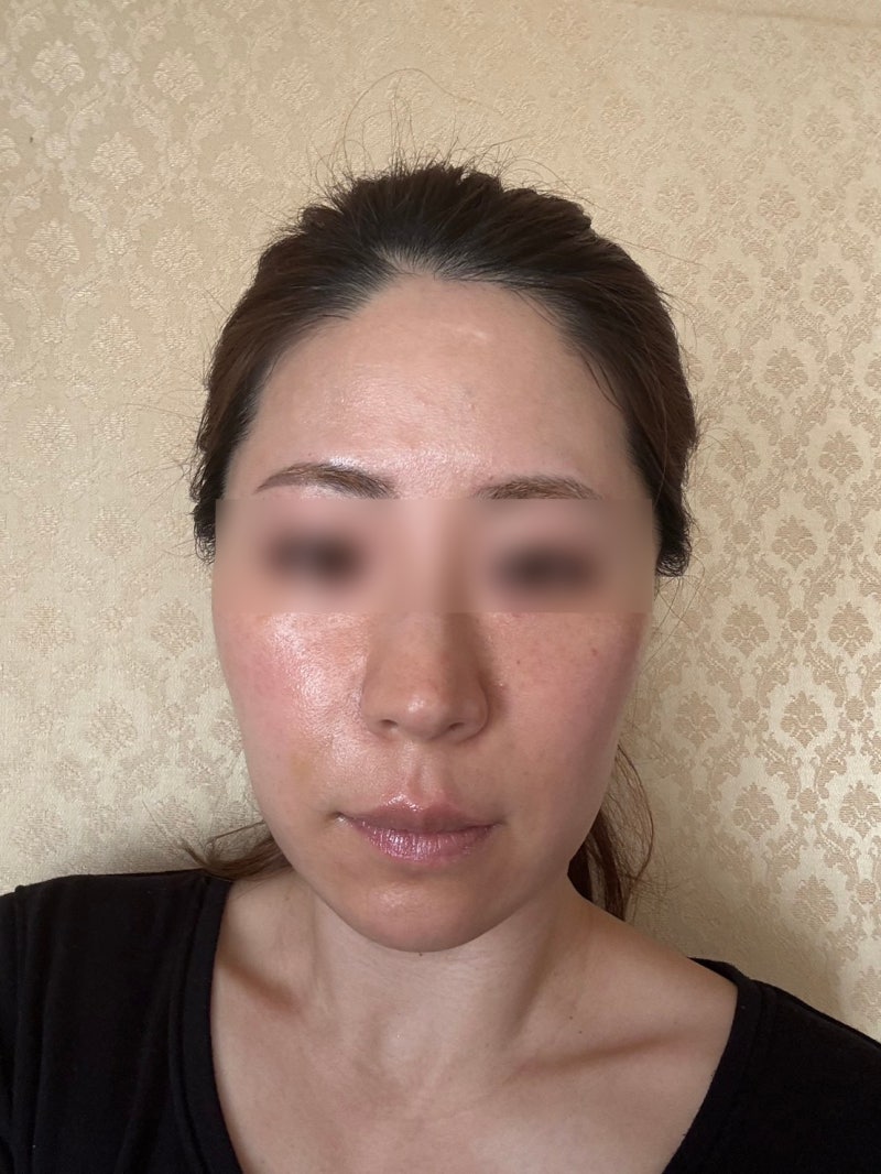 Sinnonhyeon Station Plastic Surgery Clinic: Thread Lift – How Long Do Effects Last and How Does Naturalness Differ? 사진 7