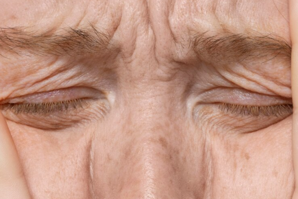 Nonhyeon Station Plastic Surgery: Thread Lift vs. Laser Lift – What's the Difference and Who Are They For? 사진 5