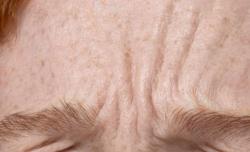 Gangnam Station Plastic Surgery: Considering a Forehead Lift? A Realistic Talk About Cost and Scars