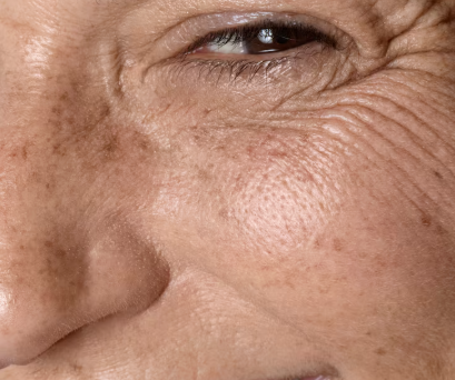 Where to get a good thread lift in Seoul? A youthful face without nasolabial folds requires a 1:1 approach, as there's n