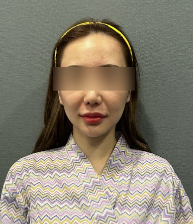 What You Need to Know Before Getting a Seoul Thread Lift Recommendation — Side Effects and Criteria for Expert Clinics 사