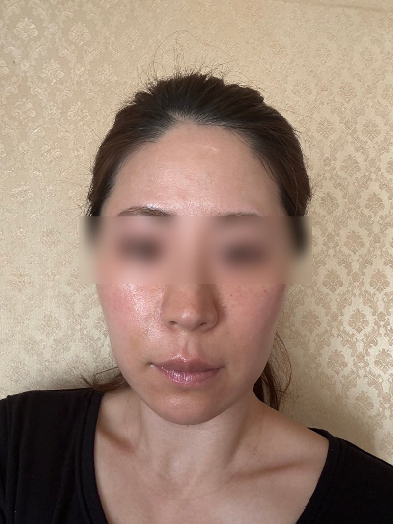 When considering a good thread lift clinic in Gangnam, check this first 사진 6