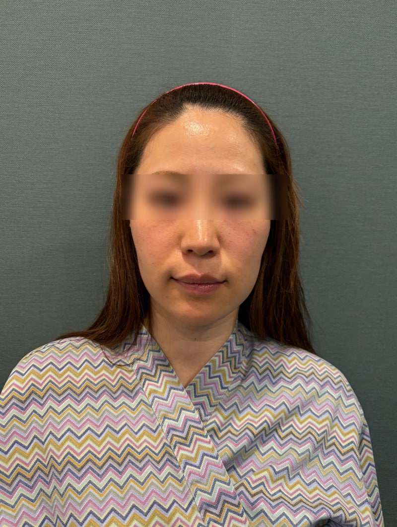 When considering a good thread lift clinic in Gangnam, check this first 사진 5