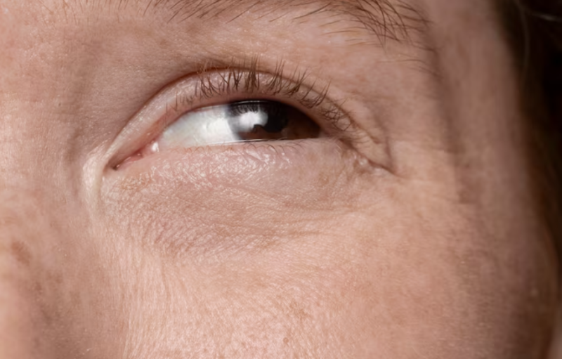 Jambersil Nasolabial Fold Lifting: How Long Does it Last? Pain and Under-Eye Application