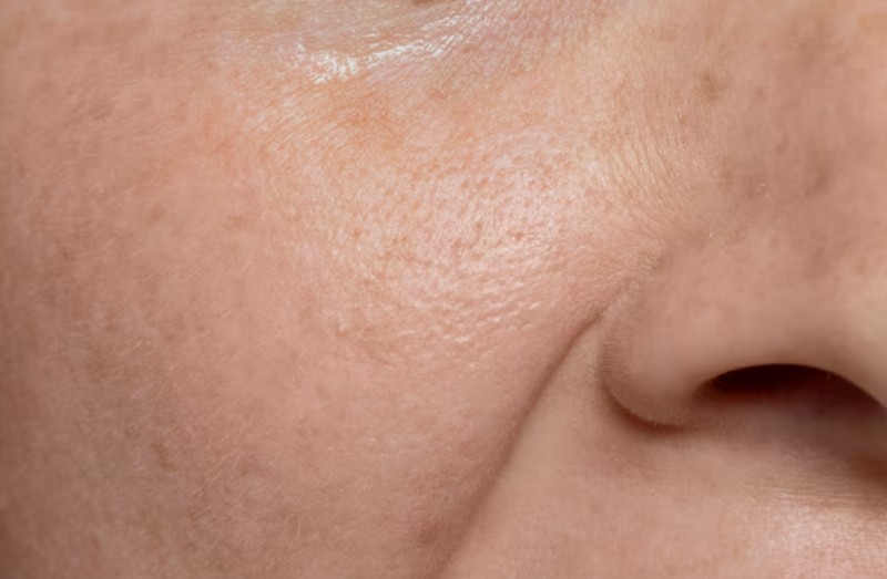 Jambersil Nasolabial Fold Lifting: How Long Does it Last? Pain and Under-Eye Application 사진 6