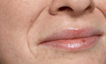 50s Thread Lift: Comprehensive Guide to Sagging Cheeks, Deep Cheek Fat, and Nasolabial Folds by Age