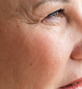 40s Thread Lift: Why Swelling, Bruising, and Naturalness Depend on Thread Type Selection 사진 6