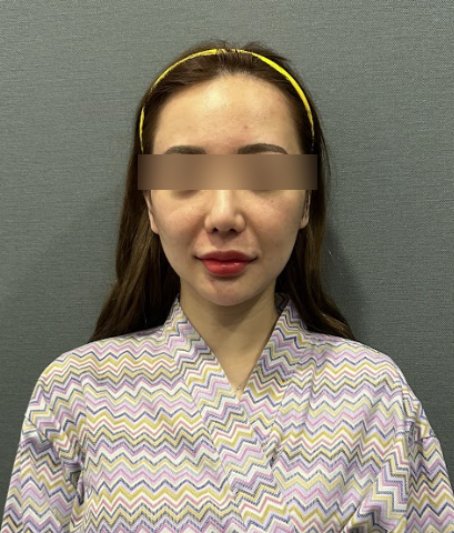 Swelling After Gangnam Thread Lift: When Can You Return to Daily Life? Effects, Bruising, and Naturalness 사진 8