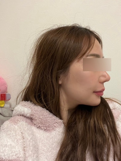 Swelling After Gangnam Thread Lift: When Can You Return to Daily Life? Effects, Bruising, and Naturalness 사진 7
