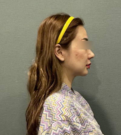 Swelling After Gangnam Thread Lift: When Can You Return to Daily Life? Effects, Bruising, and Naturalness 사진 6