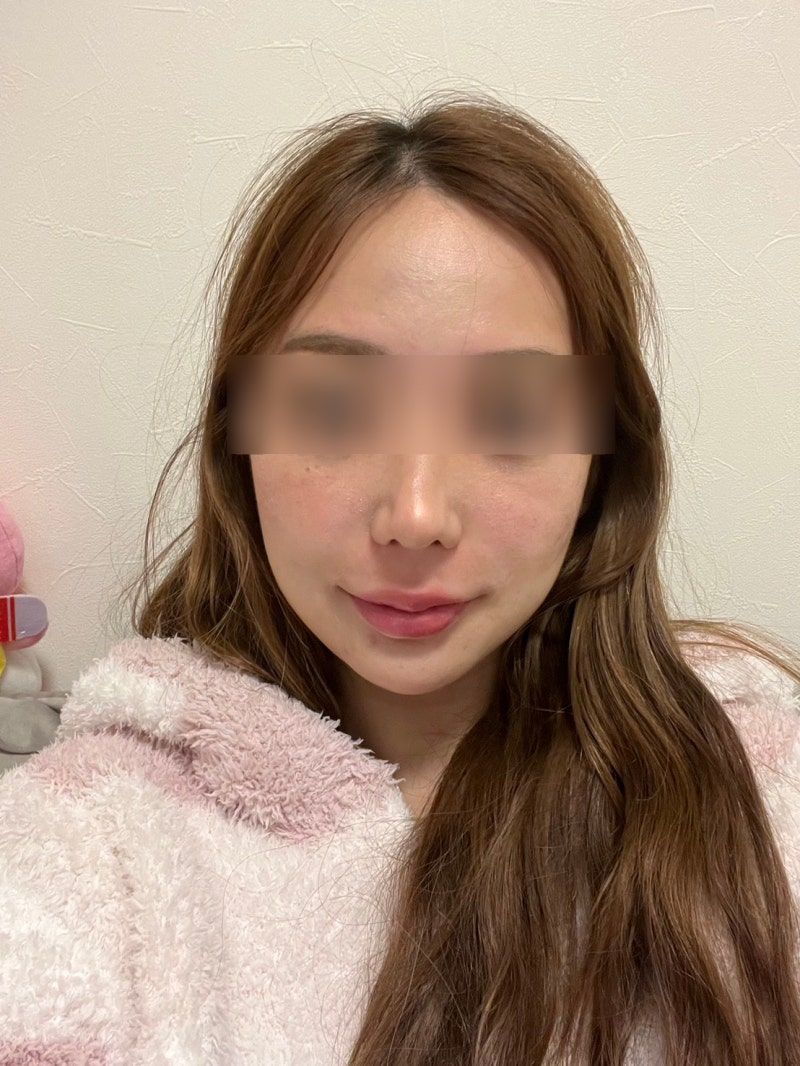 Swelling After Gangnam Thread Lift: When Can You Return to Daily Life? Effects, Bruising, and Naturalness 사진 9