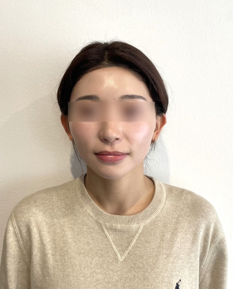 Mint Thread Lift: 2, 4, or 8 Threads? How Many Are Best? Differences in Effects Based on Facial Condition 사진 4