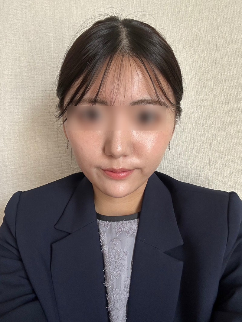 Thread Lift Bruising: How Long Does Recovery Take? Swelling and Natural Results Explained by a Gangnam Plastic Surgeon 사