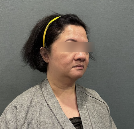 The Difference Between Custom Design and Side Effects in Facelift Surgery, Explained by the Director of a Seoul Facelift