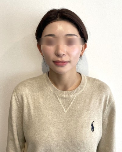 40s Facelift, Thread Lift? Which Lifting Method is More Effective for Sagging Faces? 사진 5