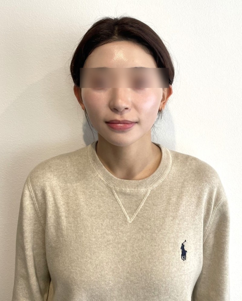 Types of Nasolabial Fold Thread Lifts: What's Different for Jowls and Deep Cheek Fat? Comparing Pain and Duration 사진 4