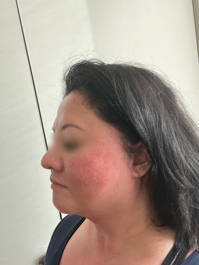Criteria for Facelift in Your 50s: Considering Cost, Contours, and Aging Together 사진 5