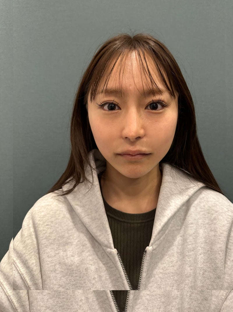 Midface Thread Lift: Effects, Duration, Pain, and Swelling When Facelift Surgery is a Burden 사진 7