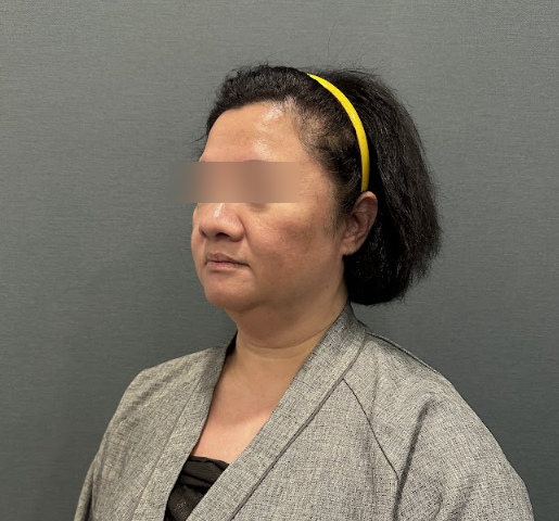 Gangnam Facelift: Most Frequently Asked Questions and Precautions Before Worrying About Aging 사진 4