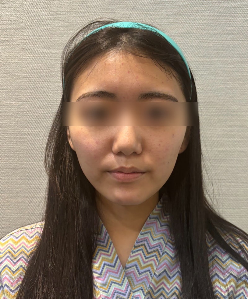 강남실리프팅 잘하는곳 선택 기준, 성형외과전문의가 설명하는 통증·붓기·멍 사진 3