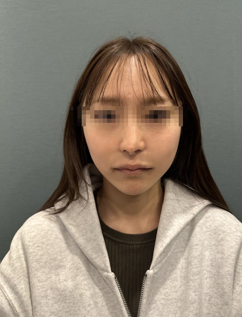 Gangnam Thread Lift Specialist: Why Do Jowls and Mid-Face Hollowing Appear Together? Differences in Thread Types and Des