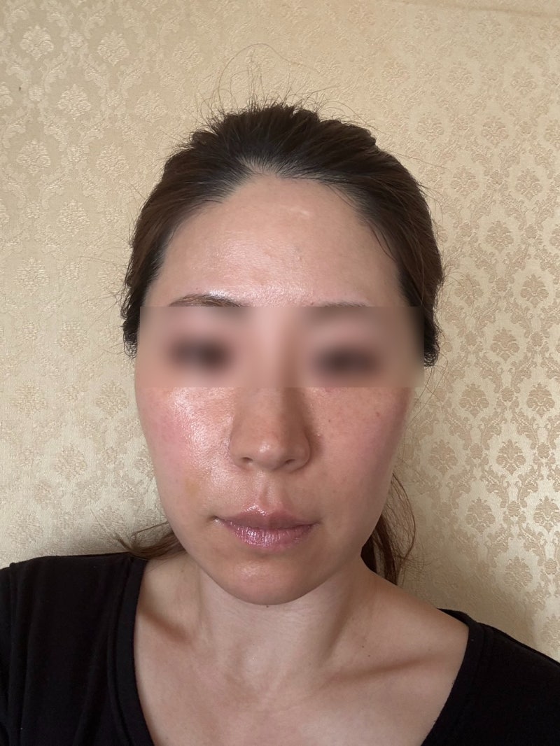 Gangnam Thread Lift Specialist: Why Do Jowls and Mid-Face Hollowing Appear Together? Differences in Thread Types and Des