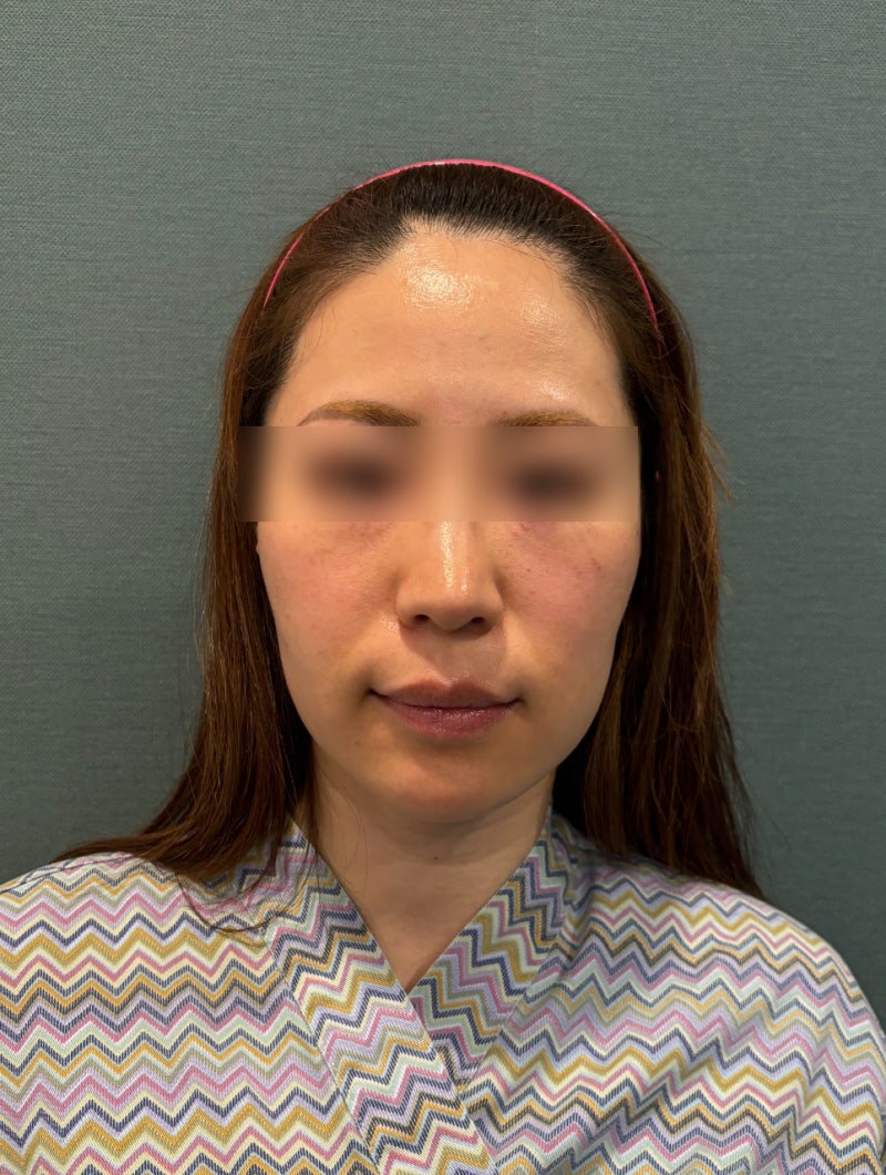 Spesialis Thread Lift Gangnam: Mengapa Deep Cheek dan Midface Hollow Terlihat Bersamaan? Perbedaan Jenis Benang dan Desa
